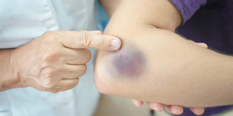 What does it mean when you bruise easily?